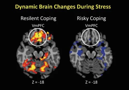 Neurofeedback Training for Burnout 1 Neurofeedback Training for Burnout